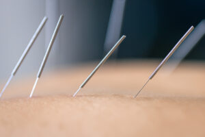 Dry needling acupuncture needles used by acupuncturist physiotherapist on patient in pain and injury treatment, close up macro photo.