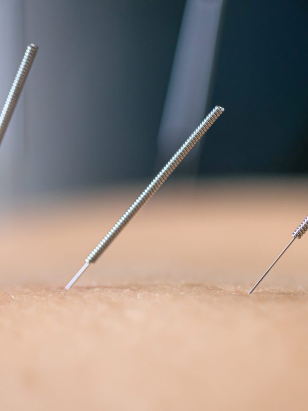 Dry needling acupuncture needles used by acupuncturist physiotherapist on patient in pain and injury treatment, close up macro photo.